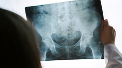 Hip Labral Tear - Common Ballet Injury